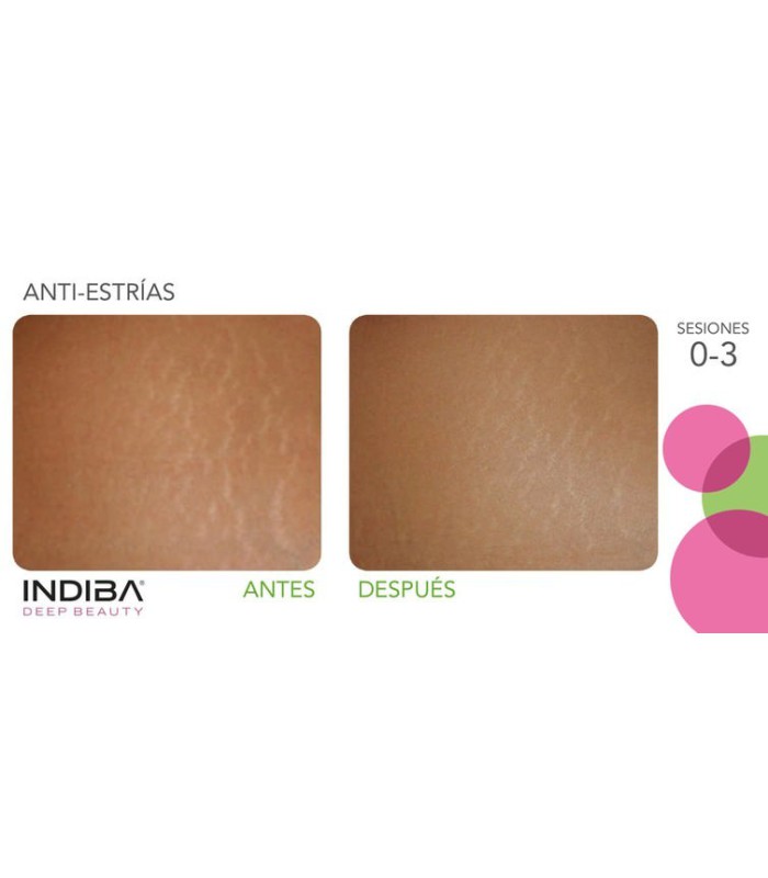 INDIBA CORPORAL 1 SESION